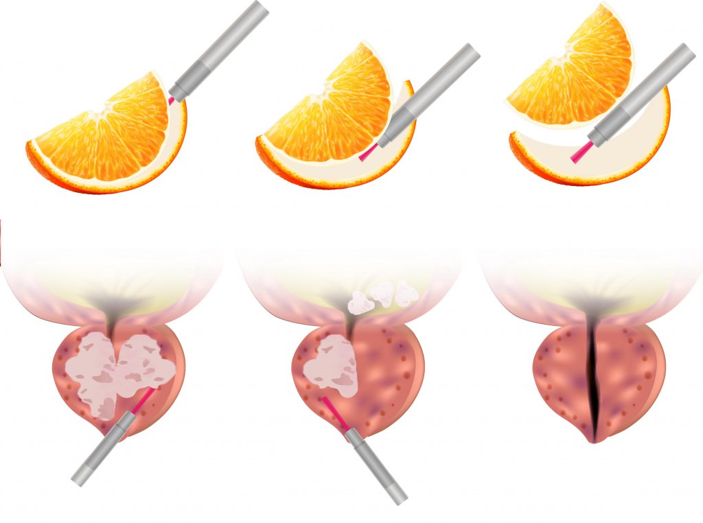 HoLEP Procedure The Urology Group